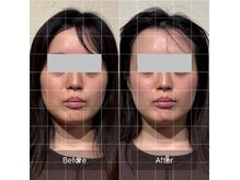 菫鍼灸院の雰囲気(頭皮鍼付き全顔美容鍼で、左右差やたるみを改善します)