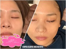 オプス ライフビューティー(OPS×LIFE BEAUTY)/小顔＆肌質改善のスペシャルケア