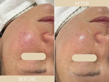 エクラ(eclat)/施術回数:1回