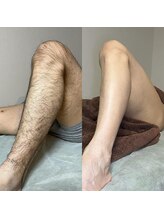 ボディデザイン ビィーラボ(BODY Design BE Labo)/人気のメンズ脱毛