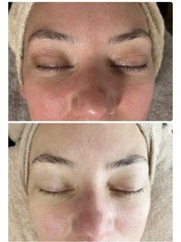 マリエンドリー/肌荒れ/毛穴/赤ら顔/乾燥