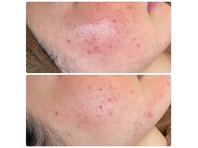 ウェリナベル(WelinaBelle)の雰囲気（天然ハーブ成分が肌に優しく働きかけ毛穴引き締めざらつき改善）