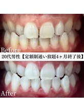 ホワイト 福岡天神店(WHITE)/ホワイトニングビフォーアフター