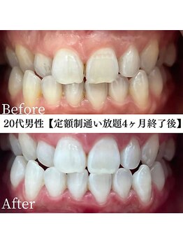 ホワイト 福岡天神店(WHITE)/ホワイトニングビフォーアフター