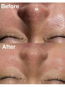 トライシフト 柏本店(TRY SHIFT)/ハーブピーリング_柏メンズ脱毛