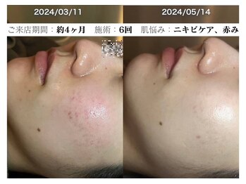 コキュウ お顔ラボ(KOKYU お顔LABO)/スキングローピール6回のお客様