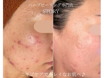 ストーリー 沼津店(STORY)/ハーブピーリング専門店STORY