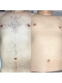 ボディデザイン ビィーラボ(BODY Design BE Labo)/人気のメンズ脱毛は最新機器で