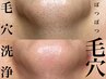 【撮影モニター価格】《黒ずみ毛穴＋開き毛穴》毛穴洗浄＋毛穴引き締めコース