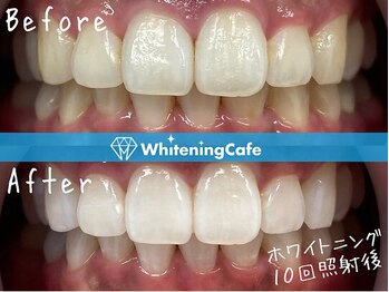 ホワイトニングカフェ 豊中店(WhiteningCafe)/◎歯のホワイトニング施術写真◎