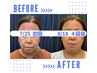 自然なハリ感を目指す50代以上へ　内側から変わる美容鍼　 ¥8,000⇒¥5,000