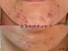 サロンヴェアリー 広尾(salon vary)/水玉リフティング　