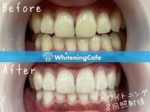 ホワイトニングカフェ赤羽店/ホワイトニングビフォーアフター