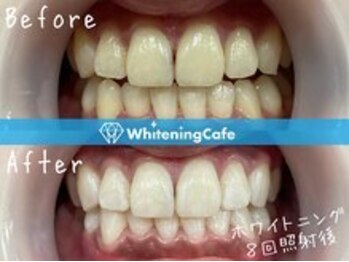 ホワイトニングカフェ赤羽店/ホワイトニングビフォーアフター