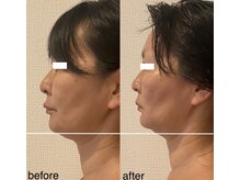 エミナル(EMINALu)/口元の歪み気になりますか？