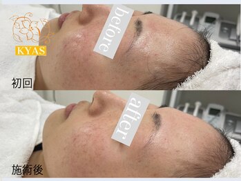 キャス(KYAS)/[ハーブピーリング]シミ肌質改善