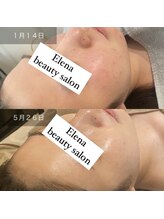 エレナ(Elena)/ニキビケアに○