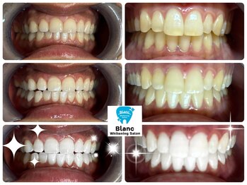 ブラン 心斎橋店(Blanc)/ホワイトニング症例