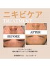 ニキビ・毛穴　【アクネ菌撃退】プラズマシャワー　16500円→