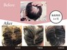 【脱毛対策/育毛促進】LEDライト＋ヒト幹細胞培養液導入¥29,700→¥14,300