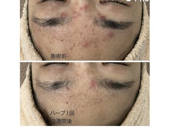 エメ 心斎橋(Aimer)/美白ブラックハーブピーリング