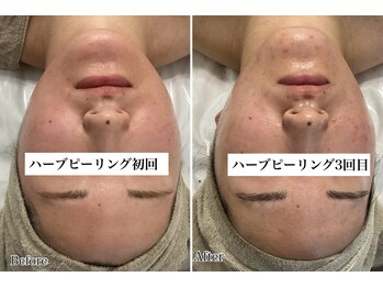 ホリシア 博多(HORISHIA)/ハーブピーリング/ニキビケア