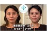 毎月限定10名【プレミアム美容鍼】お顔リフトUP＆体質ケア　¥17000→¥11000