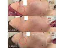 ラフェリ(Rafeli)の雰囲気(ラミネーションピール)