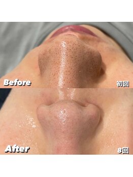 ディメンション 大里店(DIMENSION)/メタジェクト8回コースの方