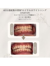 プラスビーセルフ(+b self)/ホワイトニングビフォーアフター