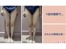 じぶんdeエステ 梅田店/CELLZERO.式　症例/太もも/1回