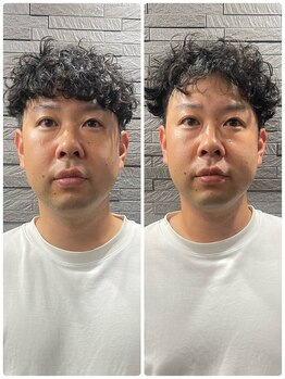 長寿鍼灸院 長寿整骨院/men's美容鍼・超絶コース★