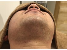 レヴィオ(REVIO)/髭脱毛