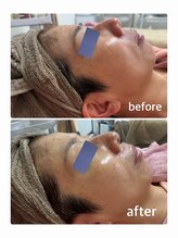 リエル(Liel)/ダクトピール1回目 before/after