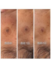 ディープブルー(Deep Blue)/プラペンデュアル施術