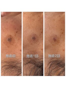 ディープブルー(Deep Blue)/プラペンデュアル施術