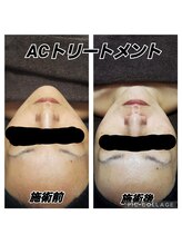 ハナ(HANA)/ACトリートメント