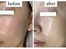 アエ(ae)/お肌の赤み、毛穴の開きにも☆