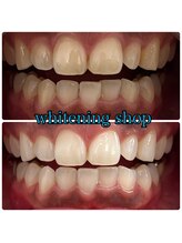 ホワイトニングショップ 大阪玉造店/Before&After美白ホワイトニング