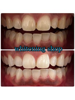 ホワイトニングショップ 大阪玉造店/Before&After美白ホワイトニング