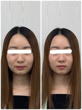 ラフテル鍼灸整骨院/ブライダル前に美容鍼×小顔矯正