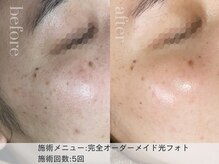 リエイト(Lieto)/完全オーダーメイド光フォト