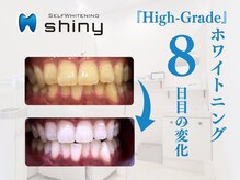 ホワイトニングサロン シャイニー 浜松細島店(shiny)/【超絶・美・白】ホワイトニング