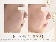 アネラボーテ(Anela Beaute)/Gloss肌ピーリング　艶玉リフト