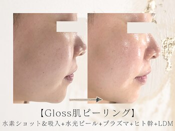 アネラボーテ(Anela Beaute)/Gloss肌ピーリング　艶玉リフト