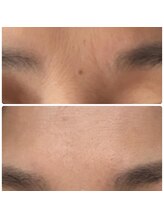 アキ/ホームケア☆眉間のタテジワ改善