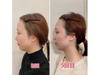 小顔22 ボルティ 本店(Bolty)/20代:5回目【悩み】面長・平面顔