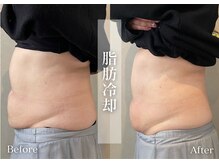 シューラディアント(ShuRadiant)/脂肪冷却