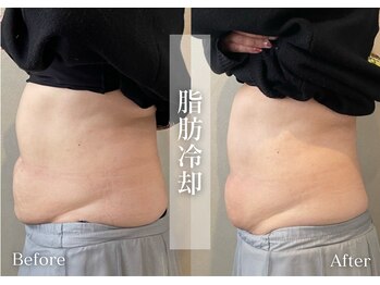 シューラディアント(ShuRadiant)/脂肪冷却