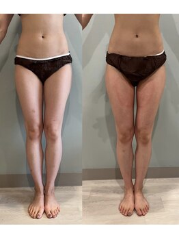 フラットベリー 恵比寿(Flat BELLY)/脂肪冷却4カップ